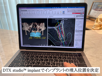 DTX studio™ implantでインプラント埋入位置を決定