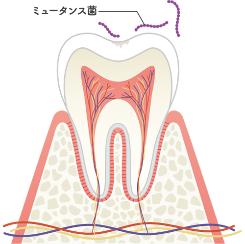 初期の虫歯の状態