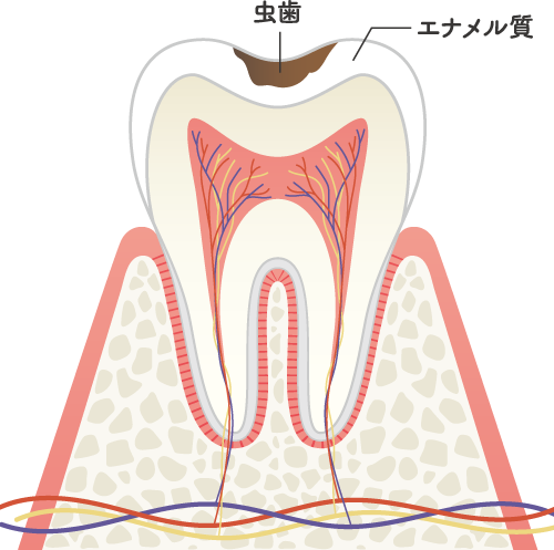 C1の虫歯の状態
