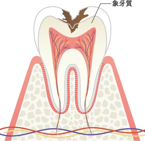 C2の虫歯の状態