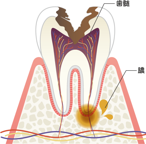 C3の虫歯の状態