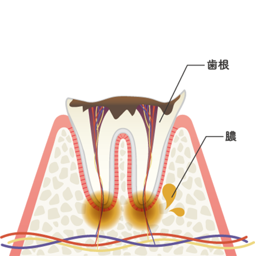 C4の虫歯の状態
