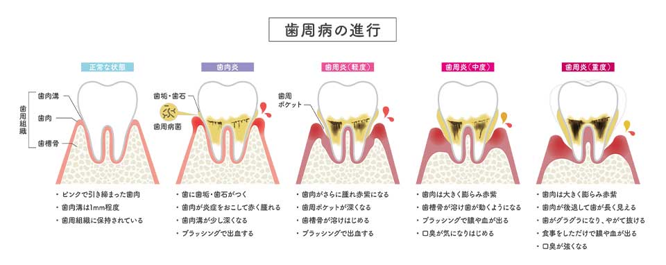 歯周病の進行のイメージ